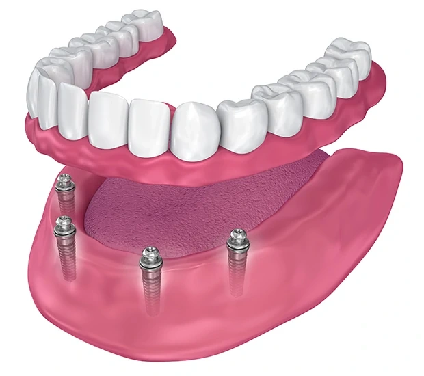 All-on-4 Implants