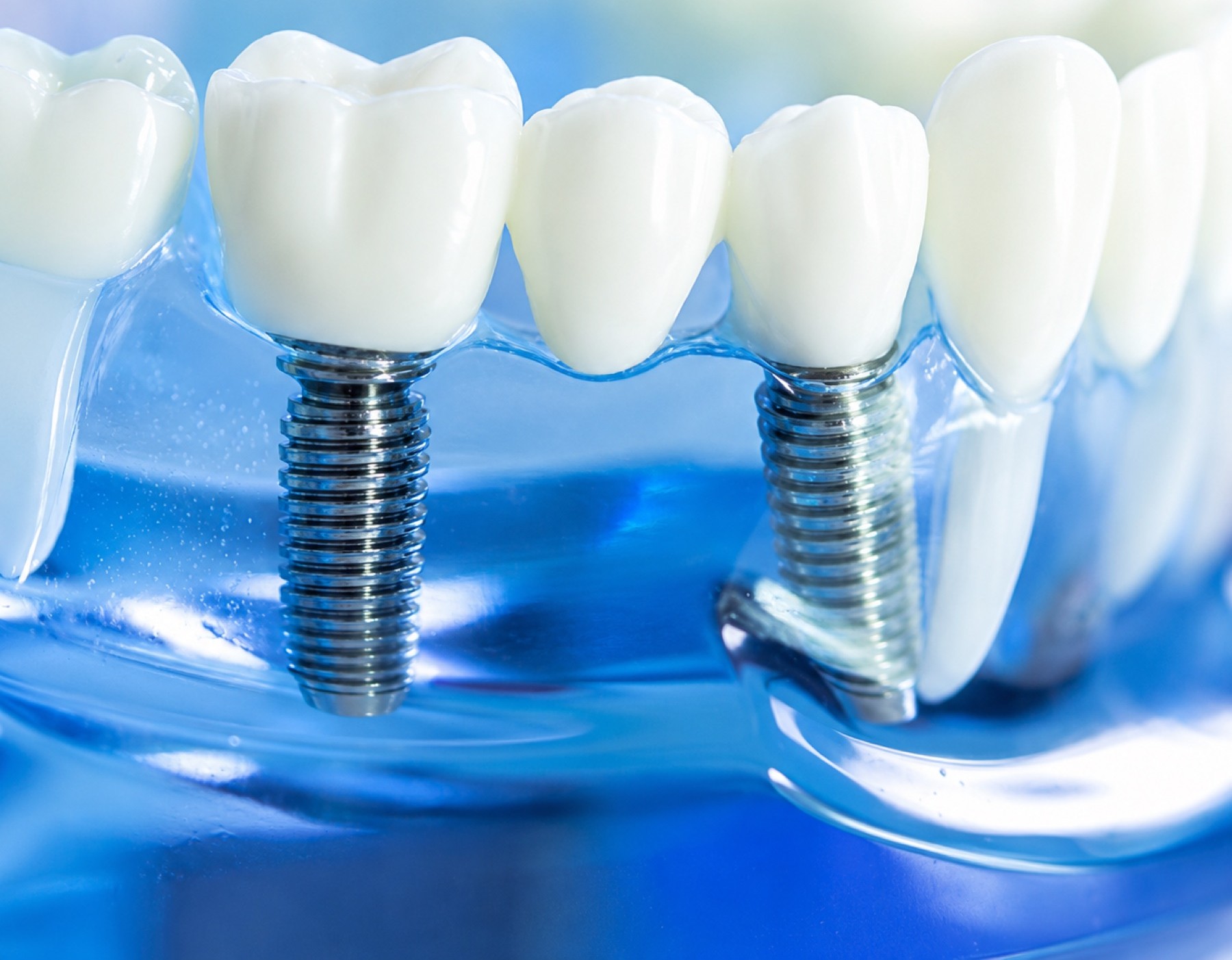 Dental Implants Guide
