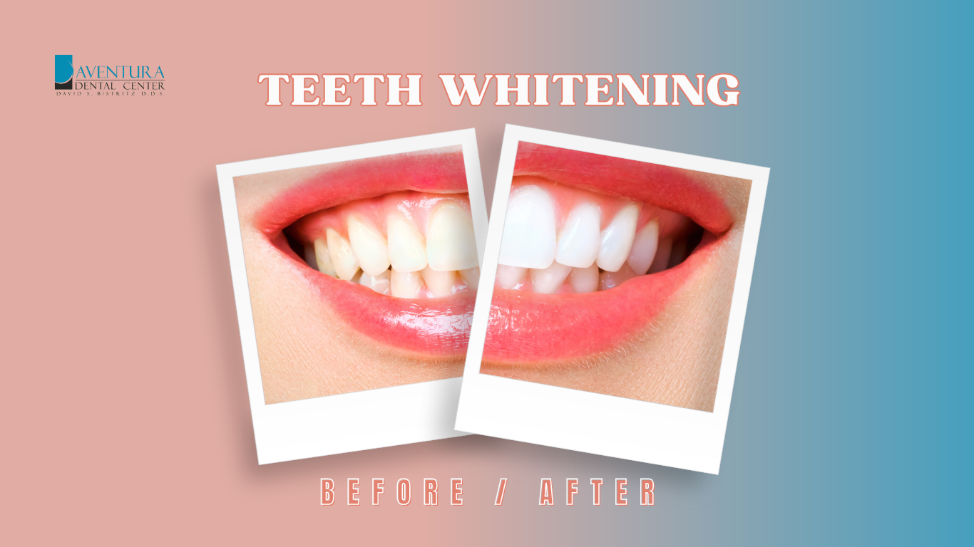 Teeth Whitening Treatment in Aventura, FL | Aventura Dental Center